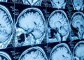 Scientists Find Signs of Brain Aging Decades Before Cognitive Symptoms