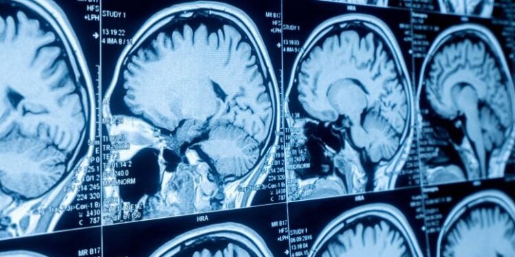 Scientists Find Signs of Brain Aging Decades Before Cognitive Symptoms