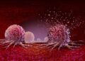 Noninvasive Cancer Treatment Looks Safe, yet 11% of Patients Died Within a Month